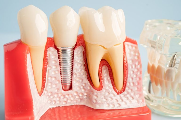 dental implants cape town-min
